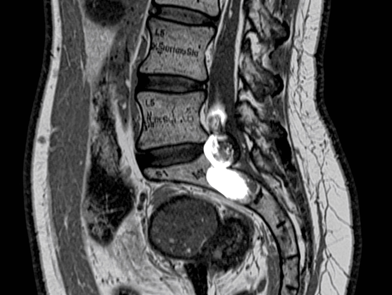MRI showing L5-S1 disc herniation
