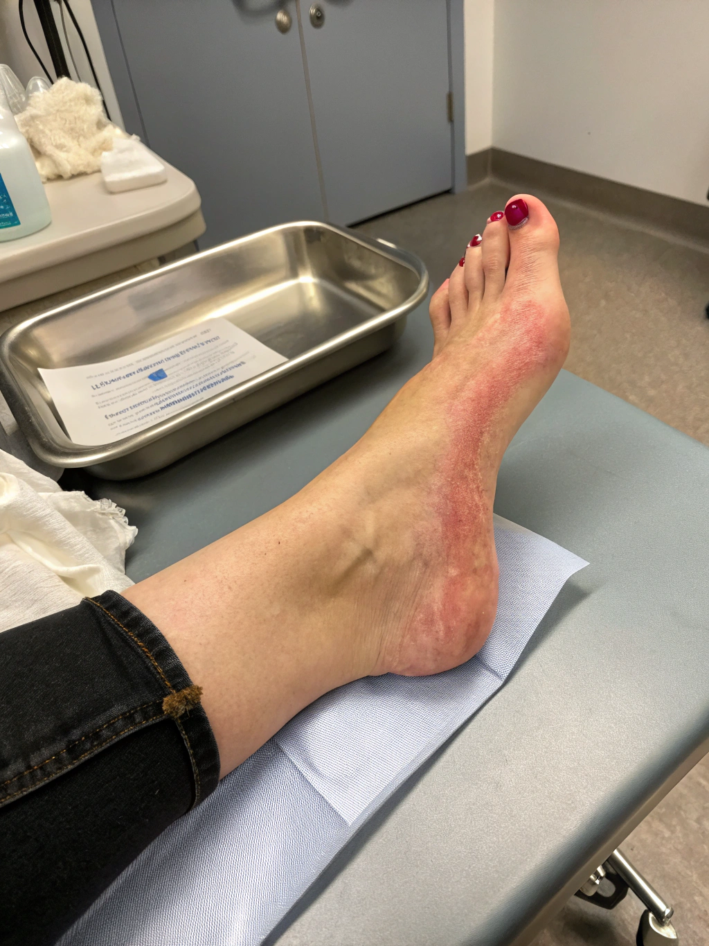 Close up of wrist showing overuse symptoms